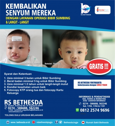 Operasi Bibir Sumbing dan Celah langit-langit di RS Bethesda Yogyakarta  Gratis !!